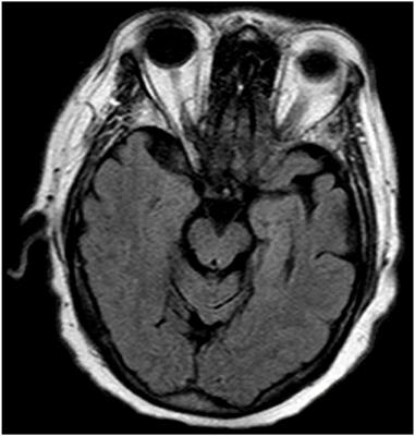 Completed Suicide by Firearm in an Individual With the Agrammatic Variant of Primary Progressive Aphasia: Case Report